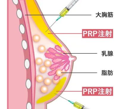 従来の豊胸術