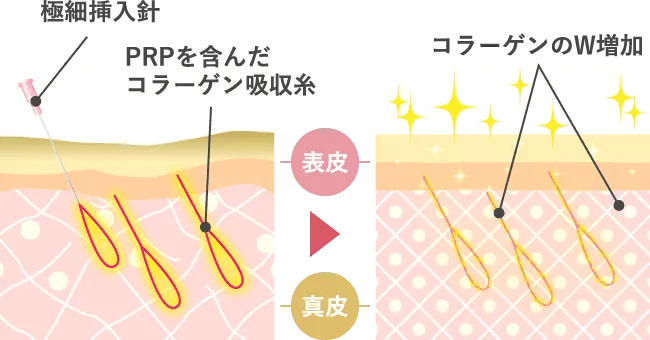 Wコラーゲン