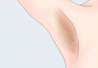 黒ずみの原因