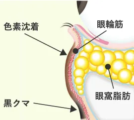 「ふくらみによる黒クマ（影クマ）と茶クマを伴った例」のイラスト