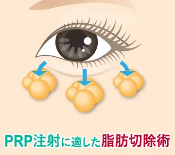 PRP注射に適した脂肪切除術のイラスト