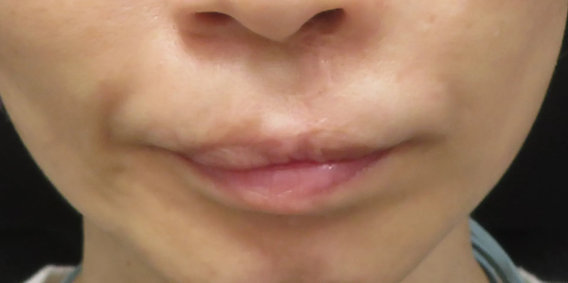 after:女性の唇