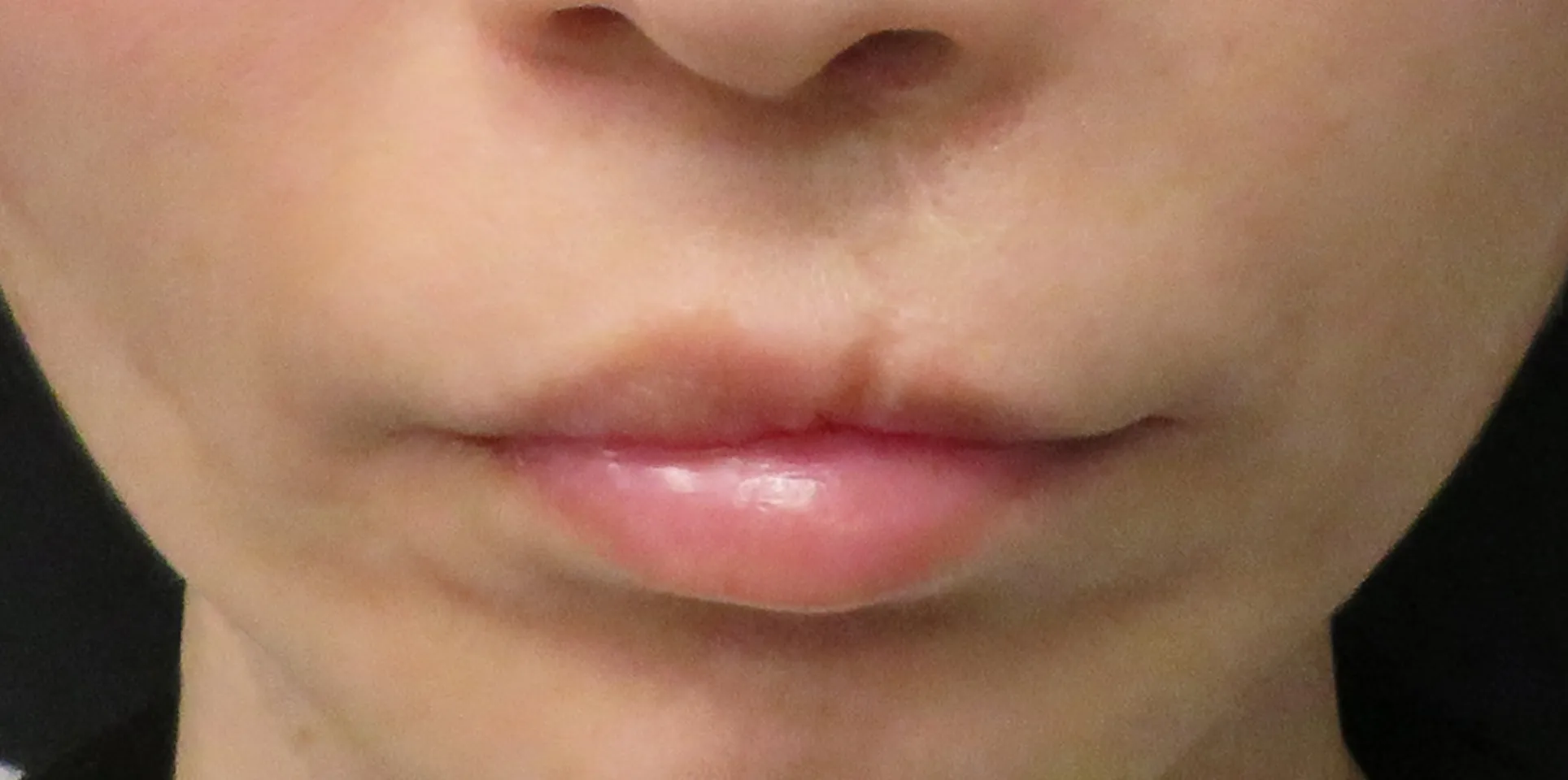 before:女性の唇