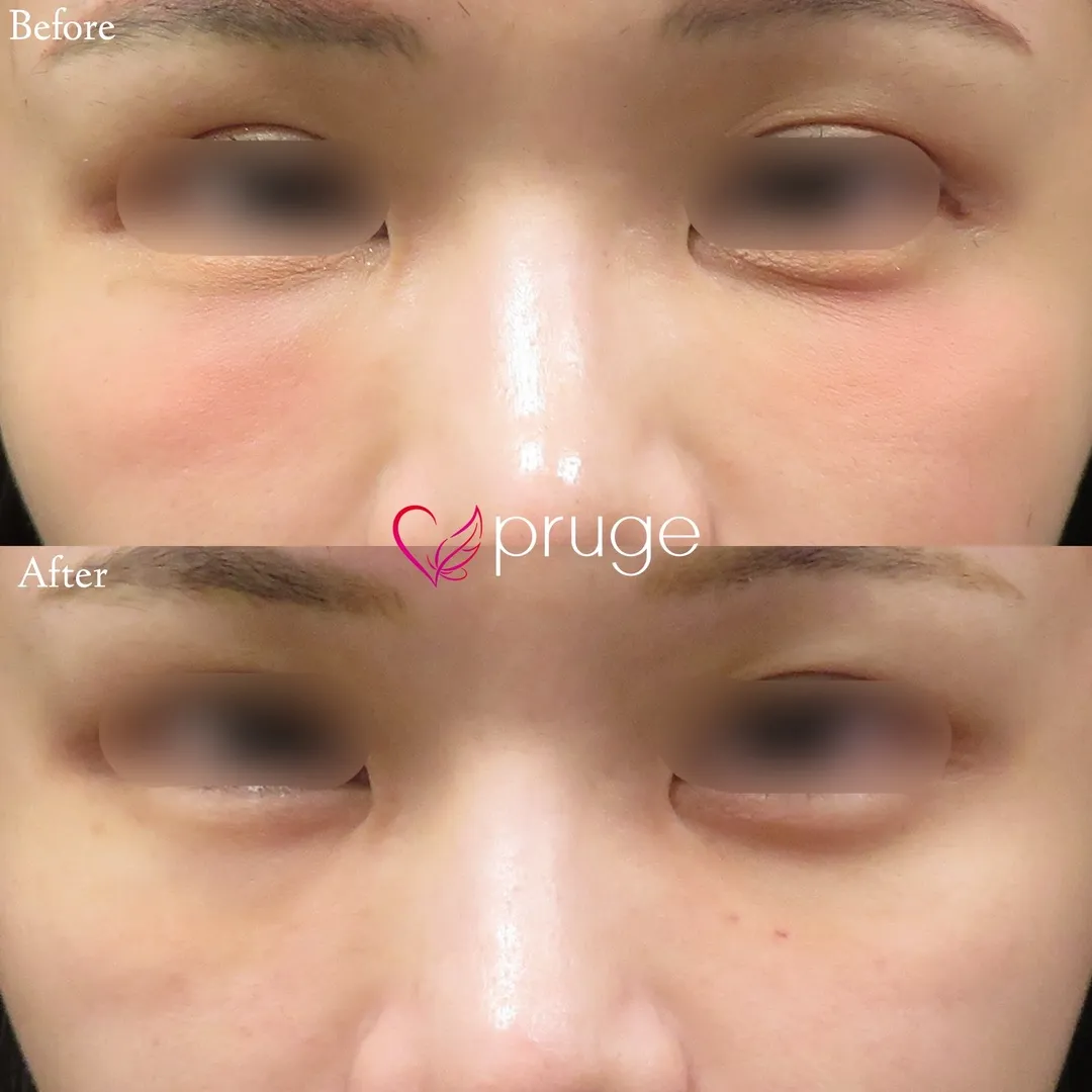 PRP＋FGF注射によるふくらみすぎ修正の症例写真