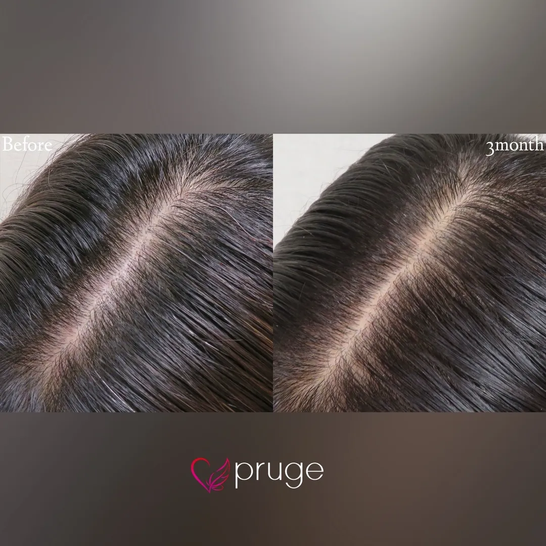 p-Scalp 1回の症例写真