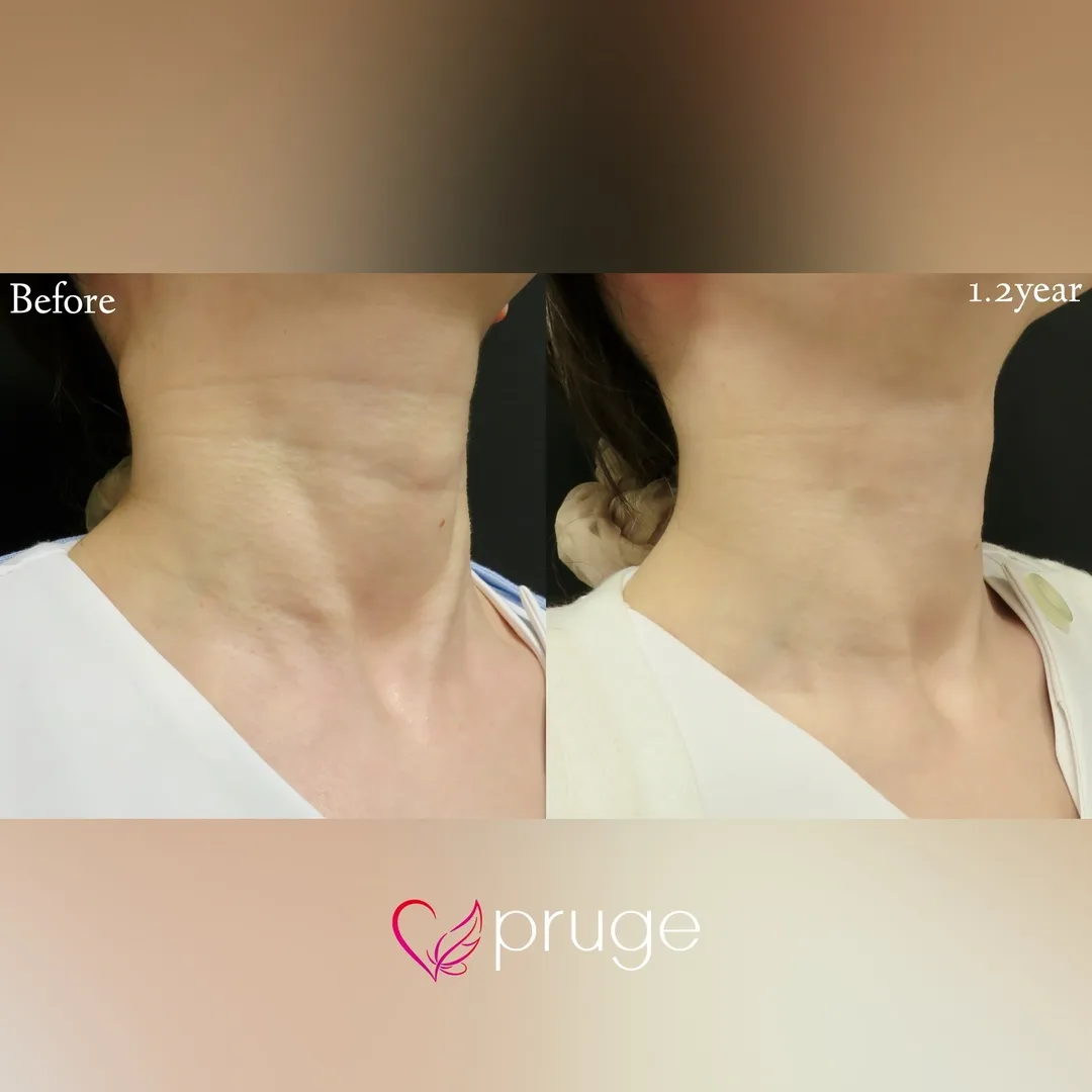 PRP注射(首)の症例写真