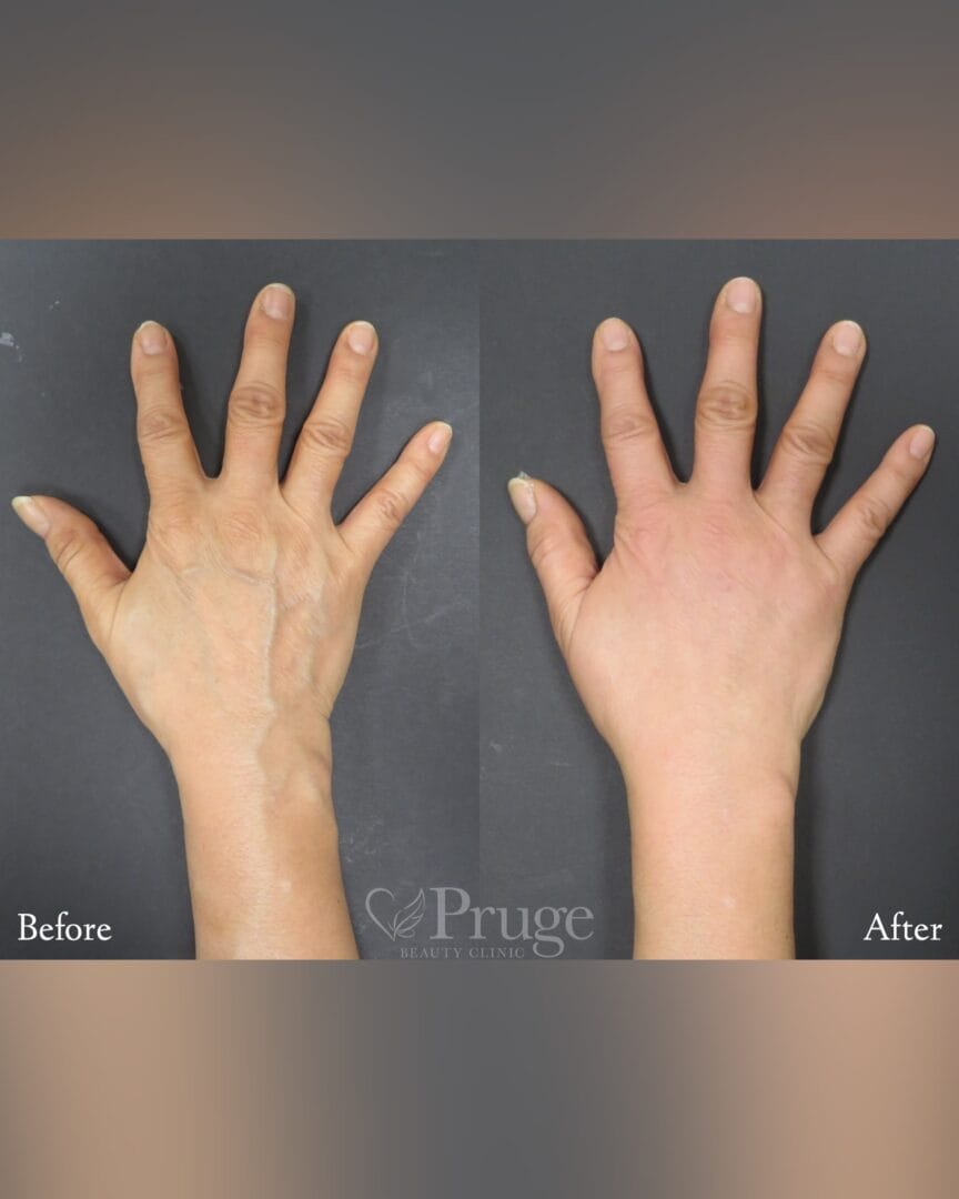 PRP注射(手の甲)・硬化療法の症例写真