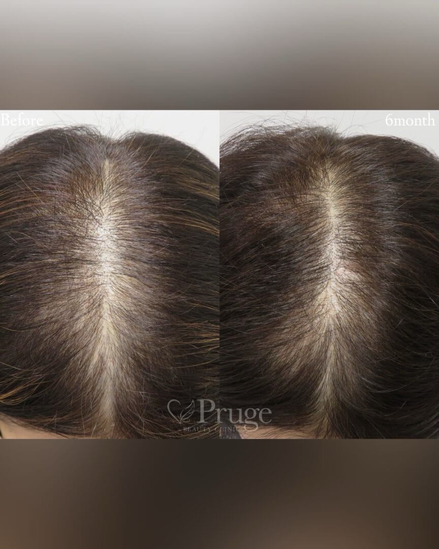 p-Scalp(１回)の症例写真
