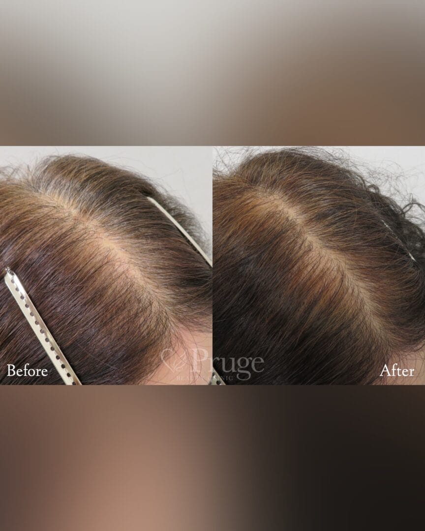 p-Scalp（1回）の症例写真