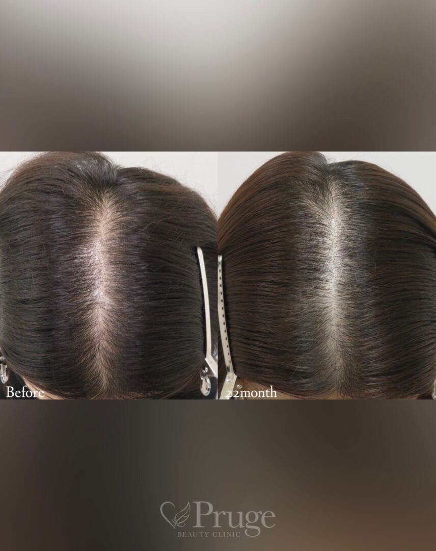 p-Scalp