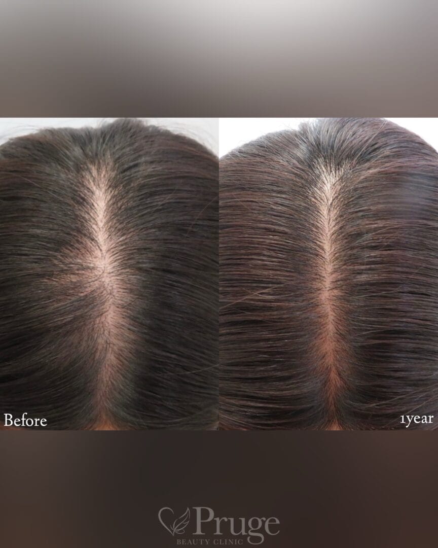 p-Scalp