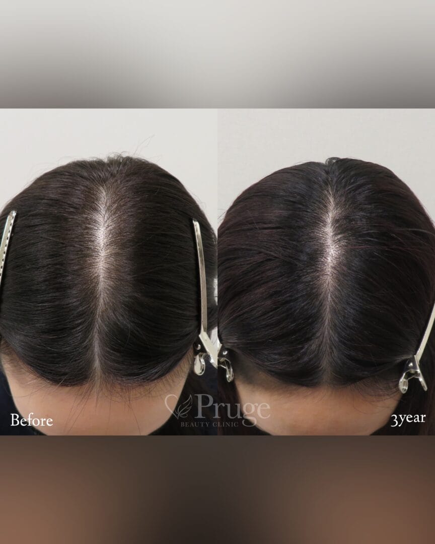 ｐ-Scalp(2回)